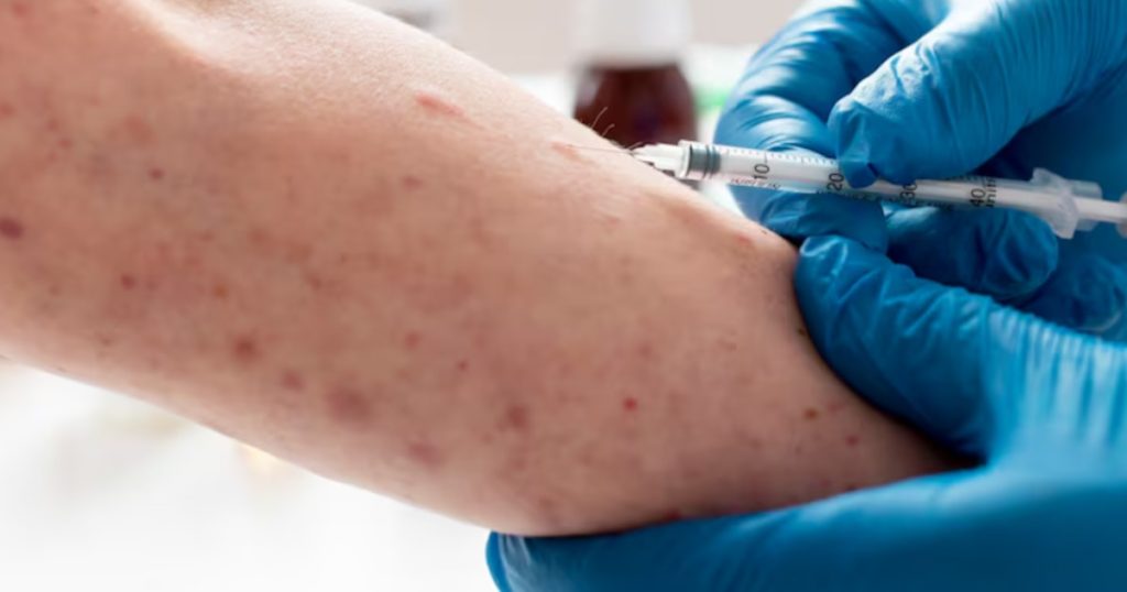Los CDC confirmaron dos muertes relacionadas con el sarampión en 2026, a pesar de que Pensilvania registra un número mayor