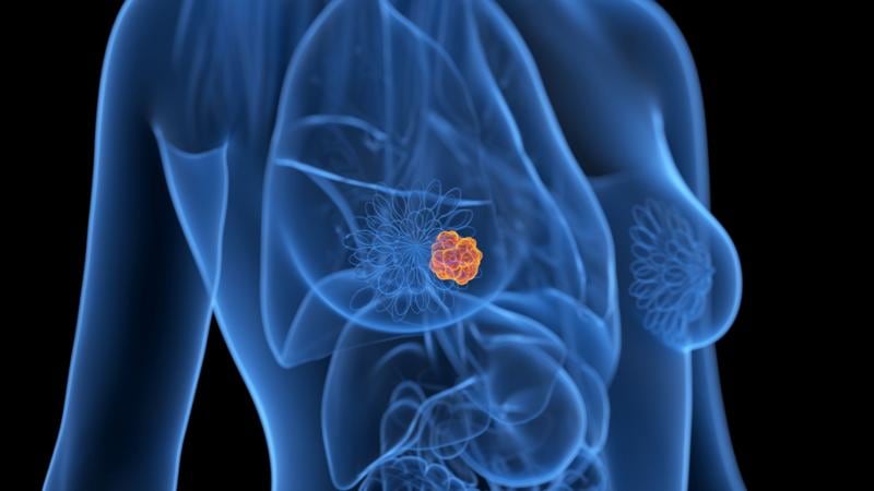 Cuándo hay que hacerse una mamografía si hay antecedentes familiares de cáncer de mama