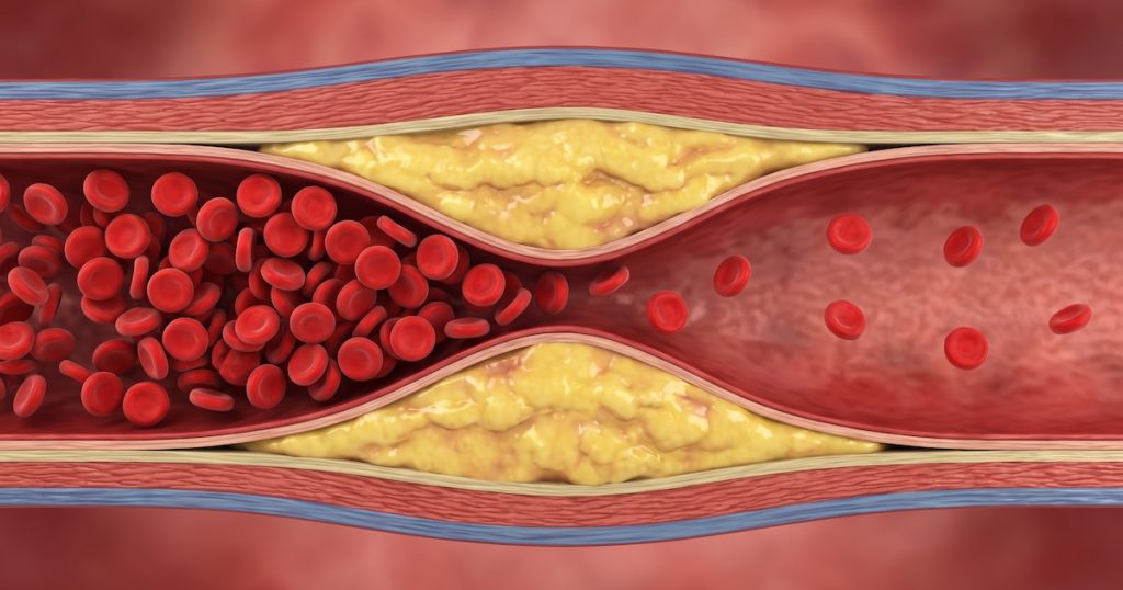 “Hay que empezar muy joven”: la advertencia de una experta para prevenir la acumulación de colesterol en las arterias y reducir el riesgo de ACV