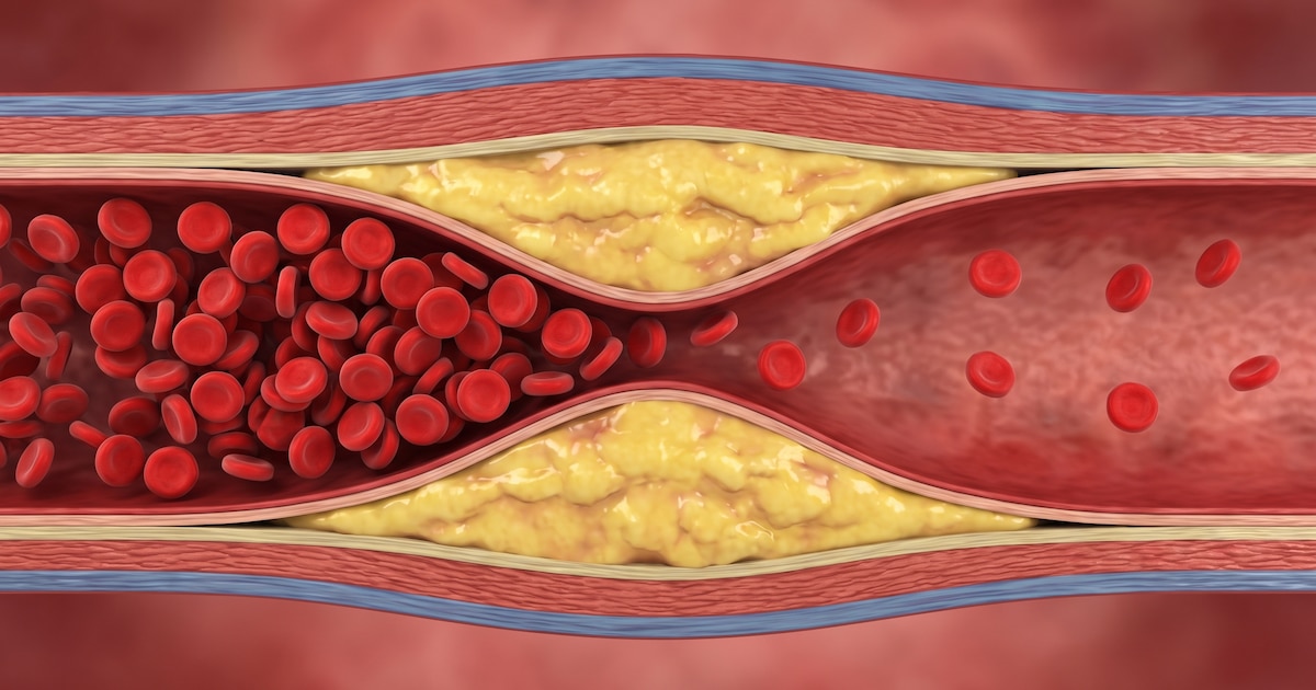 “Hay que empezar muy joven”: la advertencia de una experta para prevenir la acumulación de colesterol en las arterias y reducir el riesgo de ACV
