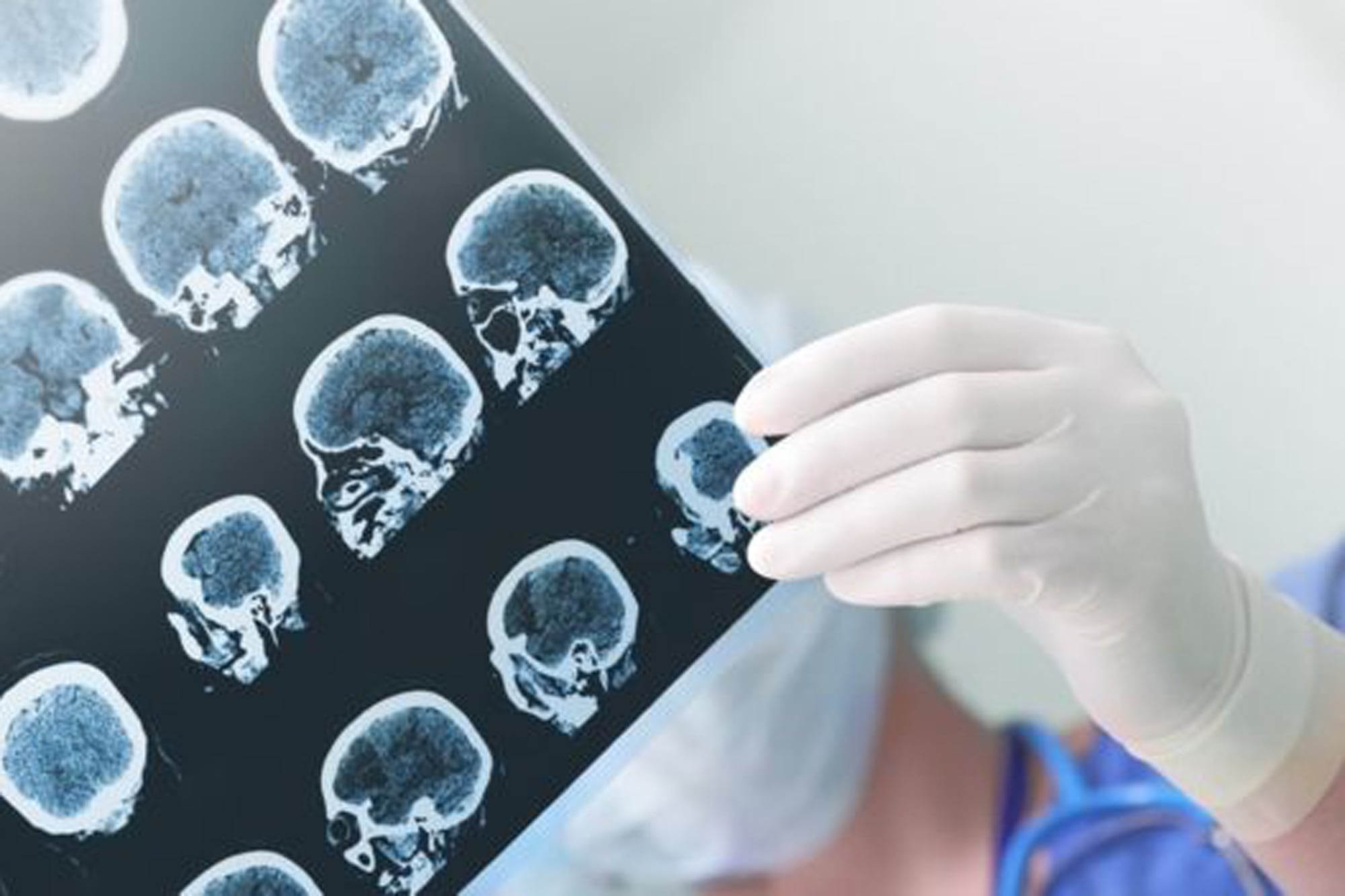 Cuál es el primer síntoma del Parkinson y cómo impacta en el día a día
